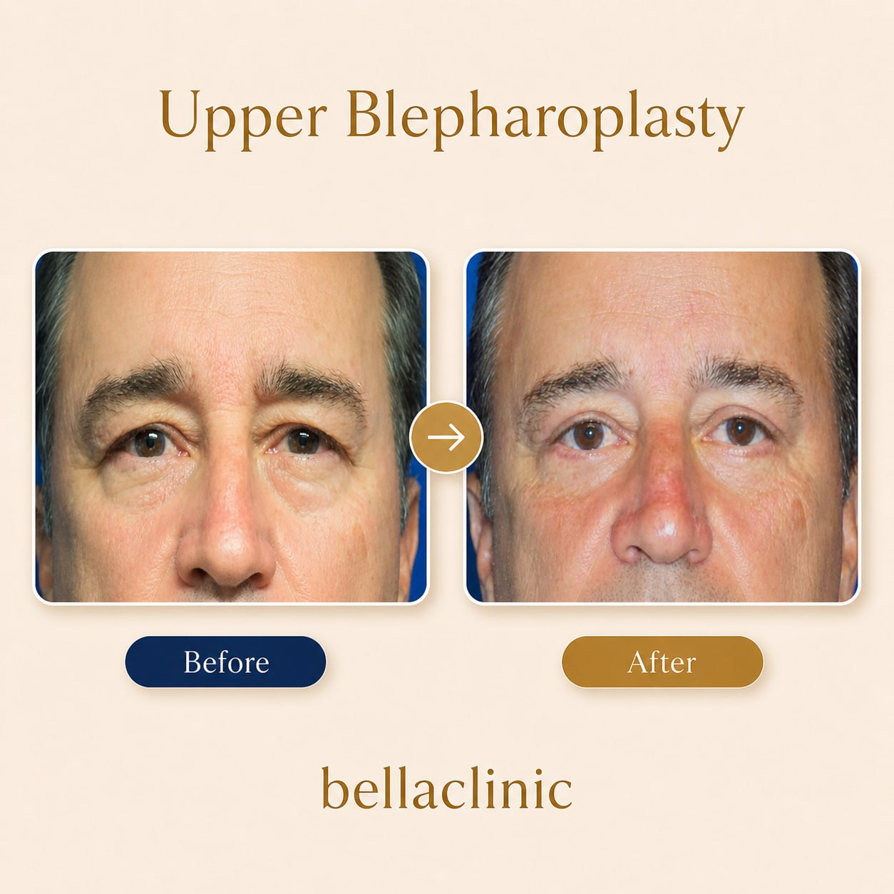 Upper and lower Blepharoplasty